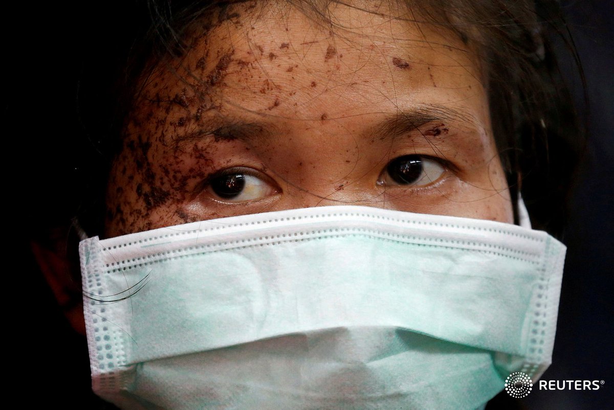 A wounded person fleeing the violence in Myanmar seeks medical treatment at a Thai border village #WhatsHappeningInMyanmar ⁦<a href="/soezeya/">soe zeya tun</a>⁩