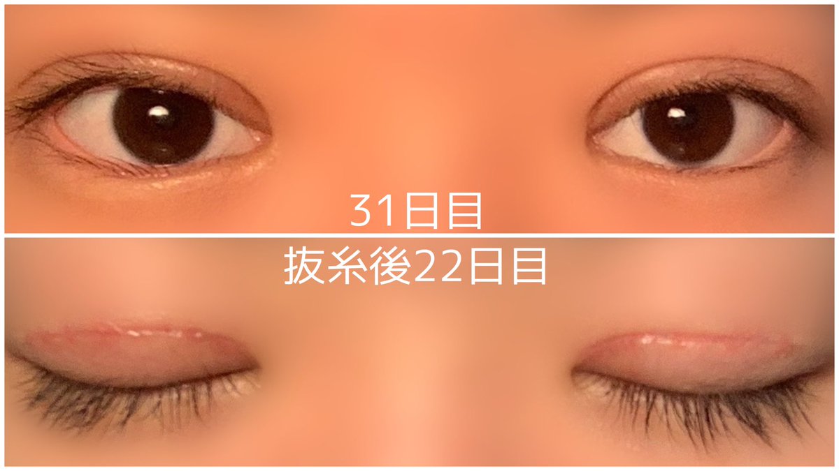 kjsnfm8's tweet photo. s南でたるみ併用全切開をして1ヶ月経ちました。
1枚目 上 元の目 下 埋没3年2ヶ月後
2枚目 施術直後
3枚目 抜糸直後
4枚目 1ヶ月後
#整形 #全切開 #たるみ併用全切開 #二重切開 #s南 #福岡院
#ダウンタイム #DT #整形垢 https://t.co/6wrK7ebvE0