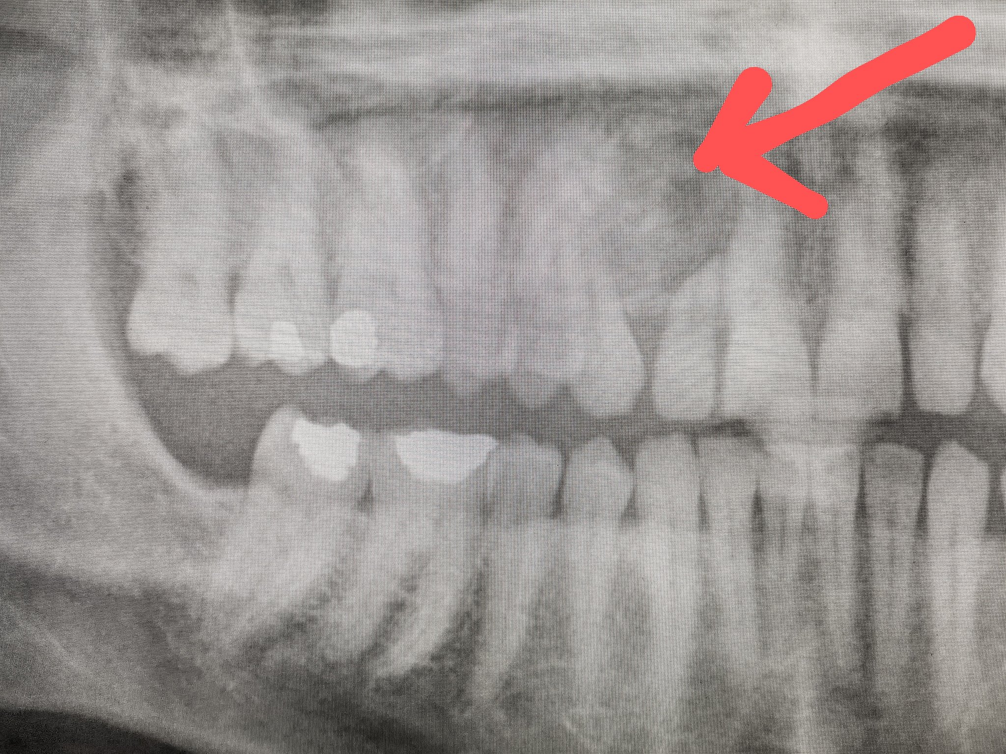 calcifying odontogenic cyst radiographic