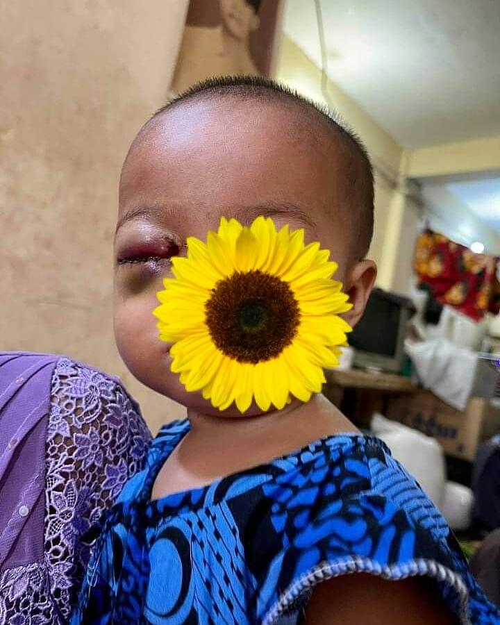 haymarn_tun's tweet photo. The one and half year baby was shot with rubber bullet to her eye by the police.
*****
This is the crime against humanity.
Our children are not safe anymore under Myanmar military coup.
#whatshappeninginmyanmar 
#crimesagainsthumanity 
#thereisnoplacefordictatorship https://t.co/CINpiVRqfS