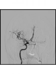 RAD Magazine (@radmagazine) on Twitter photo Check out our latest scientific article: Future trends in mechanical thrombectomy
Author: Dr Aubrey Smith, Dr Raghu Lakshminarayan
radmagazine.com/scientific-art…
<a href="/HullRadiology/">HullRadiology</a> <a href="/HullHospitals/">Hull University Teaching Hospitals NHS Trust</a>
#RADMagazine #medicalimaging #news #NHS #thrombectomy #stroke Check out our latest scientific article: Future trends in mechanical thrombectomy
Author: Dr Aubrey Smith, Dr Raghu Lakshminarayan
radmagazine.com/scientific-art…
<a href="/HullRadiology/">HullRadiology</a> <a href="/HullHospitals/">Hull University Teaching Hospitals NHS Trust</a>
#RADMagazine #medicalimaging #news #NHS #thrombectomy #stroke