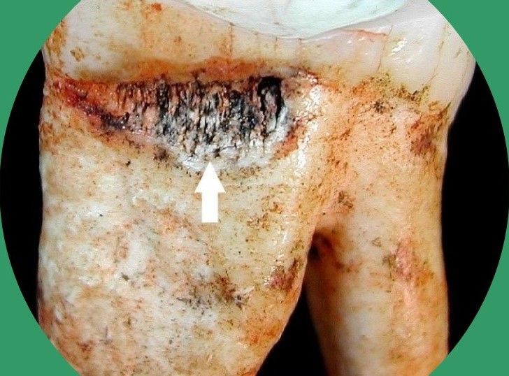 New research by <a href="/IanETowle/">Ian Towle</a> <a href="/LochCarolina/">Carolina Loch</a> <a href="/Christianne_L_F/">Christianne Fernée</a>  <a href="/DeGrooteI/">Isabelle De Groote</a> suggest that dental cavities were not as uncommon in our #fossil #ancestors as once thought. bit.ly/3rCxSnr
<a href="/otago/">University of Otago</a> <a href="/LJMU/">Liverpool John Moores University</a> <a href="/ugent/">UGent</a> <a href="/BristolUni/">University of Bristol</a> <a href="/WitsUniversity/">Wits University</a> <a href="/unisouthampton/">University of Southampton</a> 
#SouthAfrica