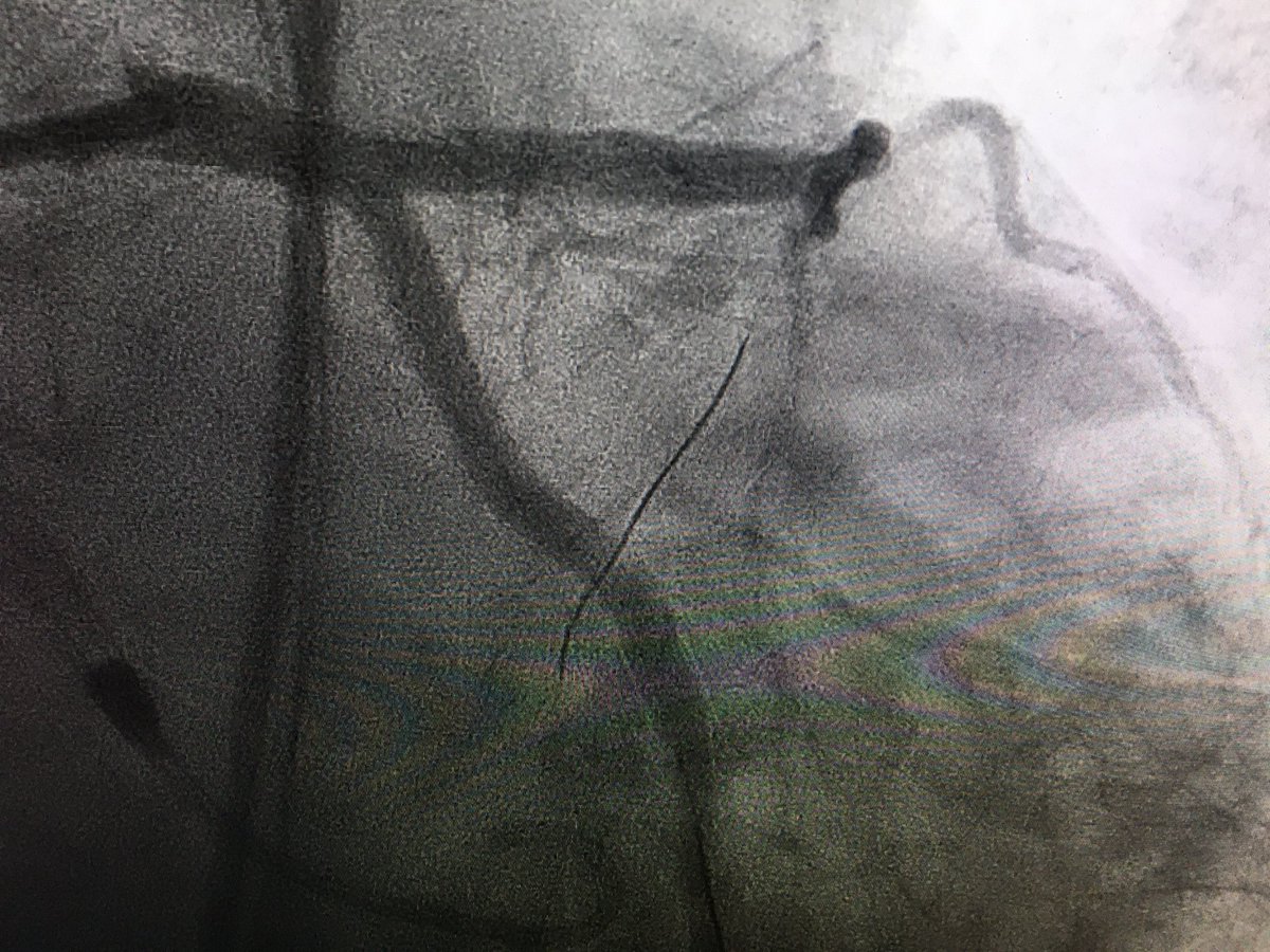 SriPittaMD's tweet image. Successful #singleaccess #impella #complexpci  surgical turndown &amp;amp; morbid obesity ( 460lbs) @SCAI @MissouriACC @txchapteracc @mirvatalasnag @HadyLichaaMD @evandrofilhobr @agtruesdell @SCAI_WIN @DrCindyGrines @BinitaShahMD @Allison_Dupont @prkothapalli