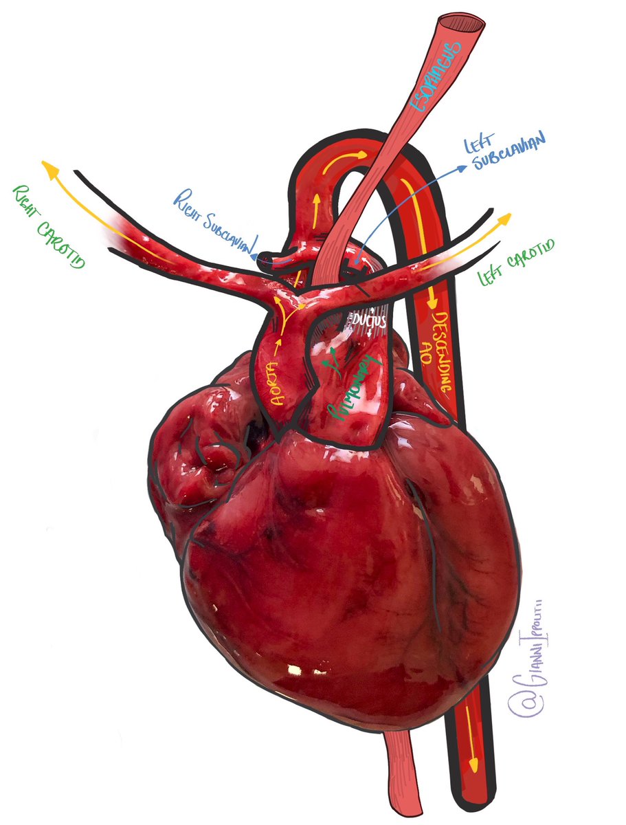 GianniIppolitii's tweet photo. Vascular ring in a neonatal autopsy: right aortic arch and left ductus arteriosus. Subclavian arteries emerge from a common retroesophageal trunk at the junction of those mentioned above. Thanks @martiponi 💜#pedipath #fetalpath #autopsy #PathTwitter #pathology #pathologist https://t.co/6kJxlQJZmW