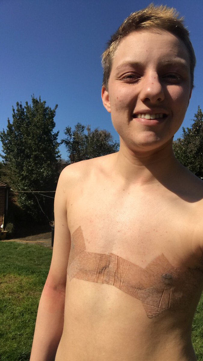 SamuelLBailey's tweet photo. A wild shirtless boy! Feel free #3weekspostop #TransIsBeautiful #TransLivesMatter https://t.co/besjLvVP0X