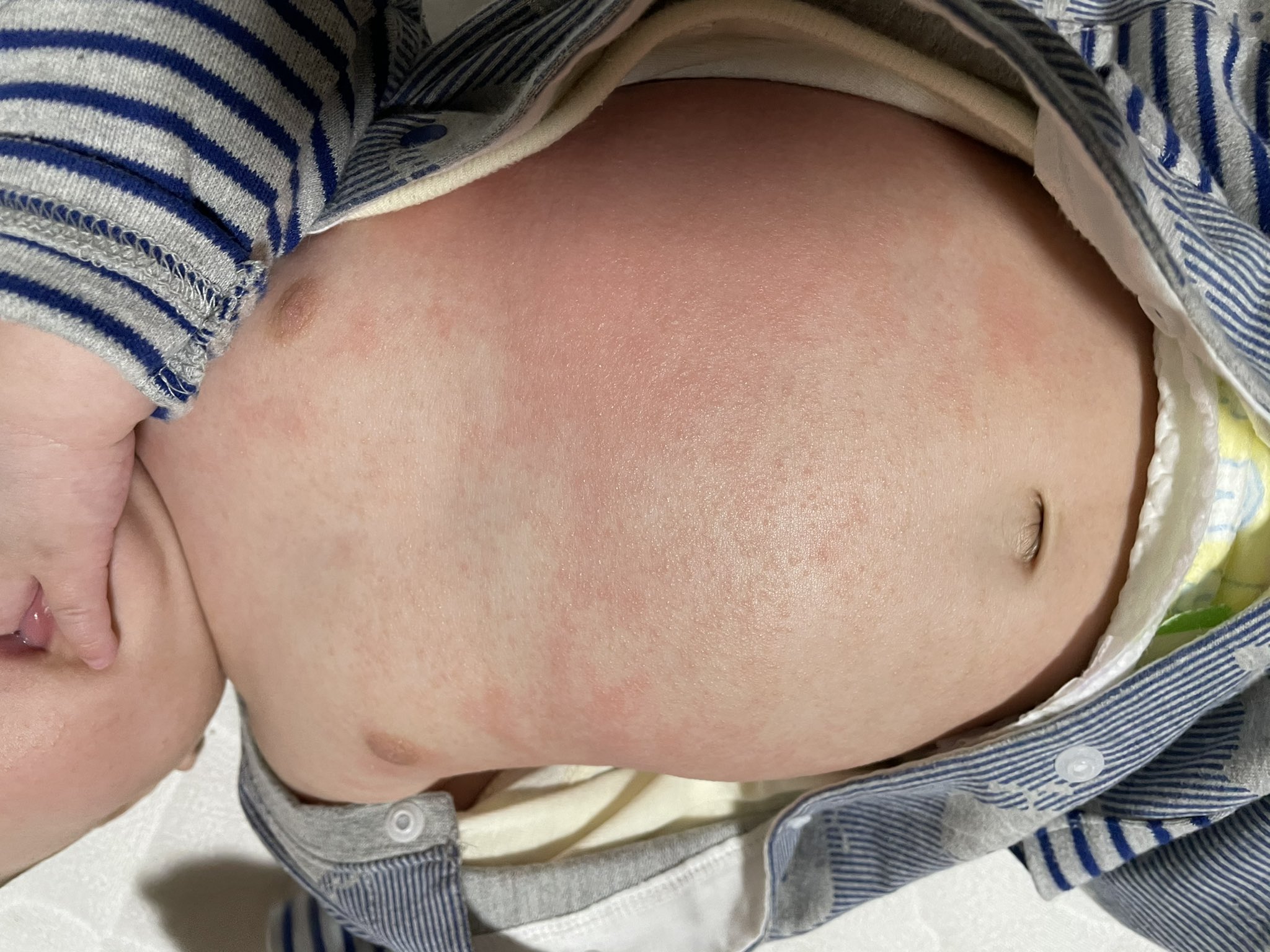 おそら 5m 11 30 41w0d むー これは乳児湿疹でいいのかな 体幹が特にひどくて腕もちらほら 頭皮も赤くて痒そう まさかアトピー T Co Xe1lky2ovs Twitter