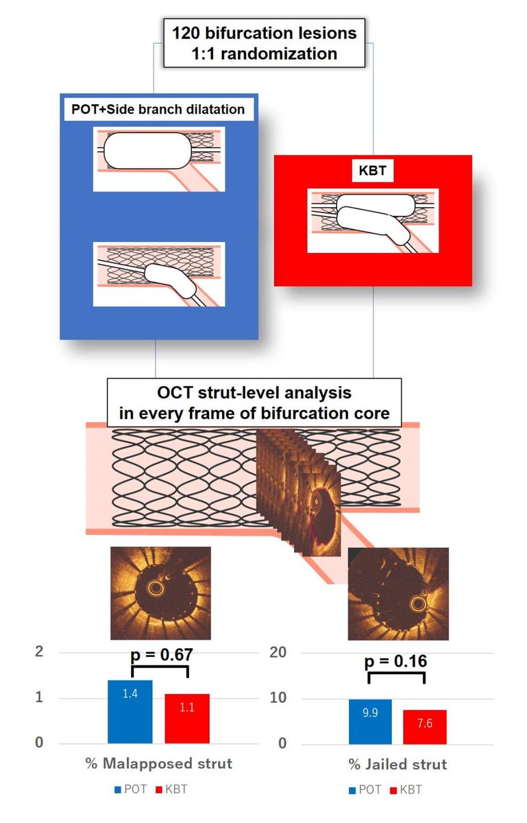 EuroInterventio's tweet photo. "Proximal Optimisation Technique Versus Final Kissing Balloon Inflation in Coronary Bifurcation Lesions: the Randomised, Multicenter PROPOT Trial" by Yusuke Watanabe et al. #EAPCI 
https://t.co/heEbjZsrPd https://t.co/8rAFLX0Vv7