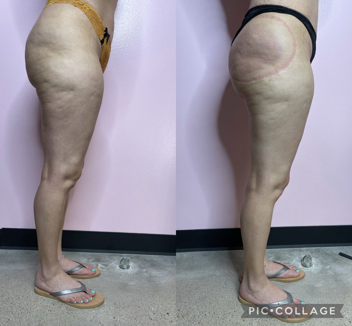 BarbieEsthetics's tweet photo. 2/4 BUTT LIFT 🍑
 
We getting right ALL AROUND ✨ 
#investinyourself #bodysculpting #buttlifting #vaccumtherapy #booknow #barbiedreamesthetics https://t.co/rF9KeqceRb