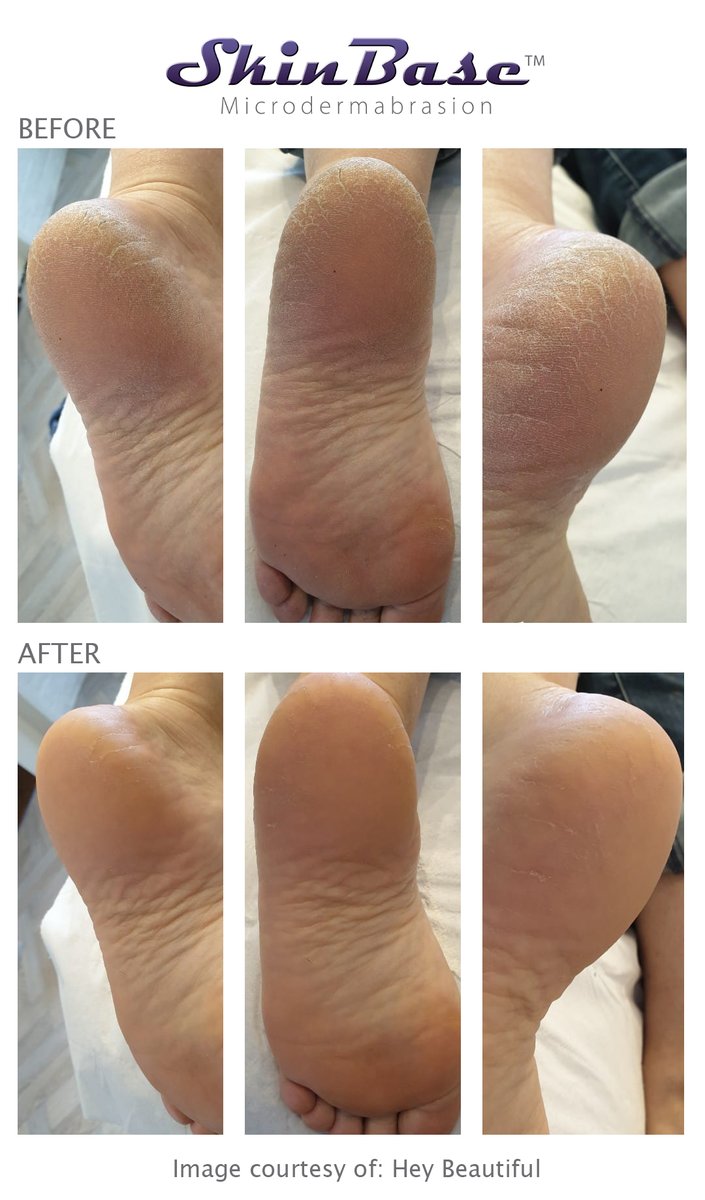 SkinBase_facial's tweet photo. Just look at those feet! Hey Beautiful Salon have really worked their magic on this client to get those feet in shape. Not long until salons reopen and with sandal season on the horizon, it's time to get booked in. Find a therapist at: https://t.co/T2x9QmzBRy https://t.co/nAN4YvOCId