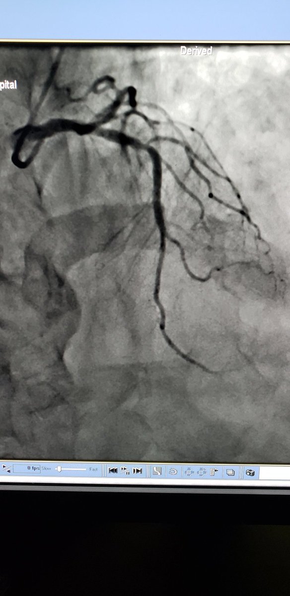 DrKareemNiazi1's tweet photo. ⚡SHOCKWAVE! and OCT imaging to tackle a difficult calcified mid LAD stenosis. Only 4atm pressure needed and no other predilatation balloon used! How are others finding this new technology? #cardiotwitter https://t.co/WMdAxYI1E2