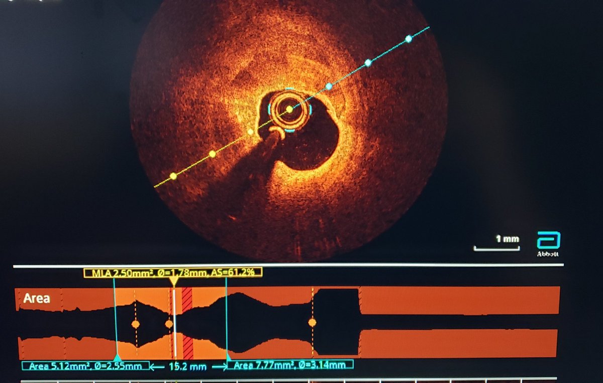 DrKareemNiazi1's tweet photo. ⚡SHOCKWAVE! and OCT imaging to tackle a difficult calcified mid LAD stenosis. Only 4atm pressure needed and no other predilatation balloon used! How are others finding this new technology? #cardiotwitter https://t.co/WMdAxYI1E2
