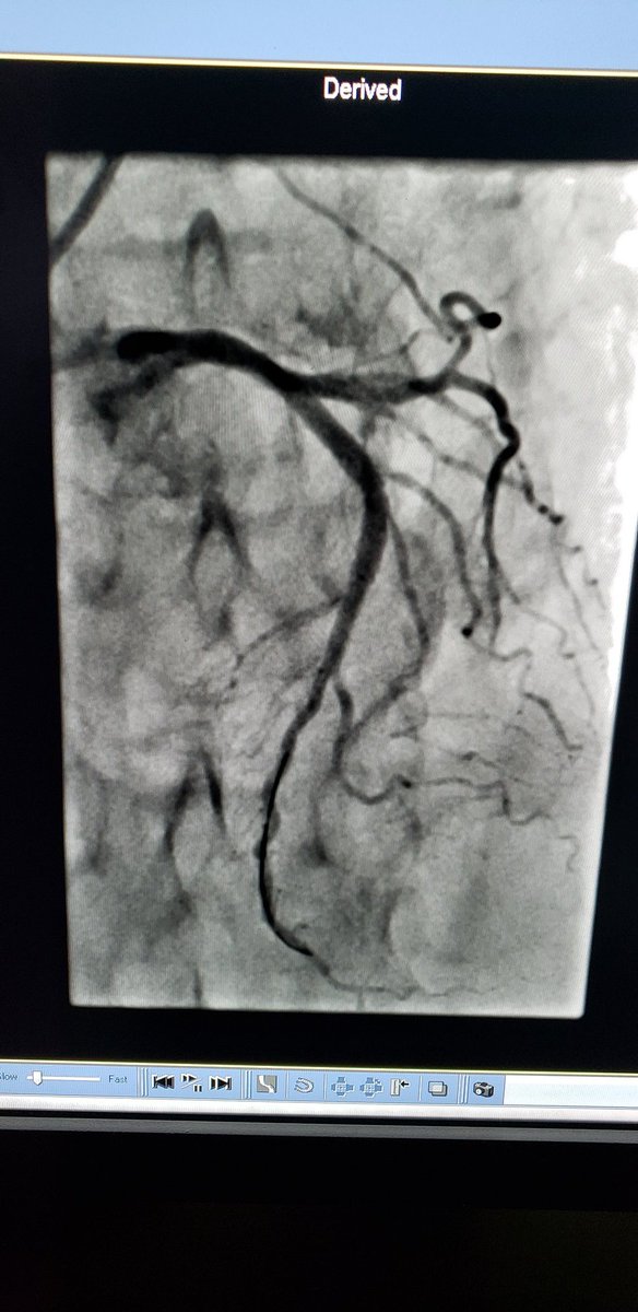 DrKareemNiazi1's tweet photo. ⚡SHOCKWAVE! and OCT imaging to tackle a difficult calcified mid LAD stenosis. Only 4atm pressure needed and no other predilatation balloon used! How are others finding this new technology? #cardiotwitter https://t.co/WMdAxYI1E2