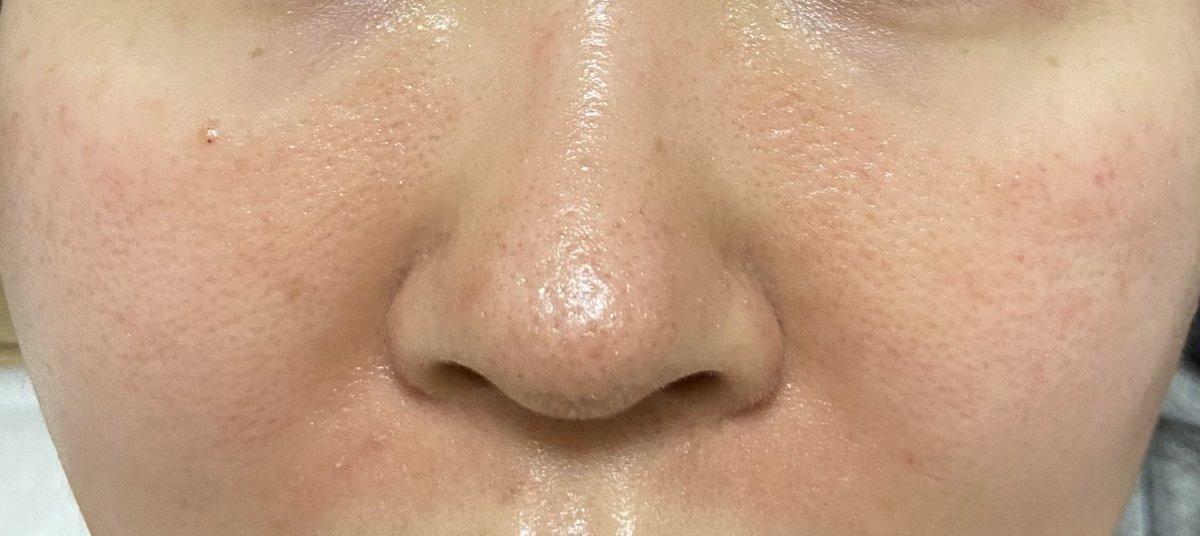 モチカ ダーマペン4 シャネル注射dt2日目朝 肌のゴワツキがはじまったー 皮剥けの前兆かな 赤みは大分収まったので引き続き保湿と紫外線対策