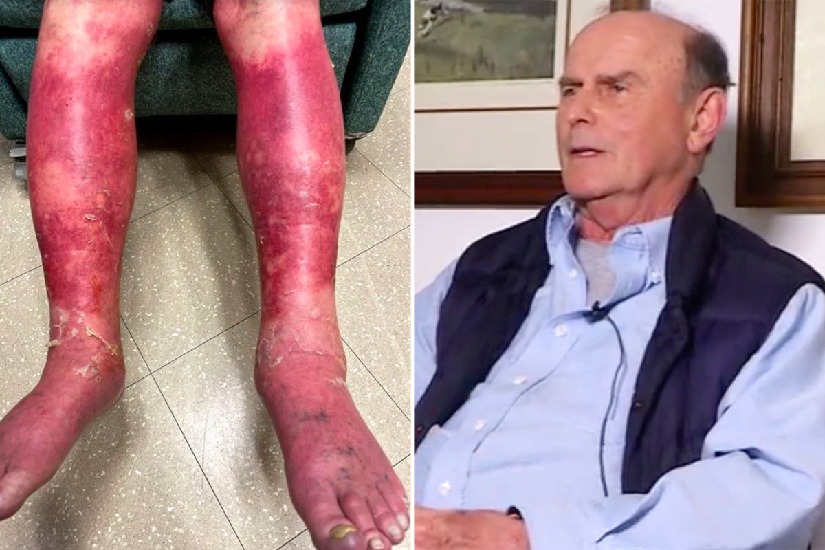 nypost's tweet photo. Man's skin 'peeled off' in rare reaction to Johnson &amp; Johnson COVID vaccine https://t.co/kJ0WE1BD60 https://t.co/e707vpjX0l