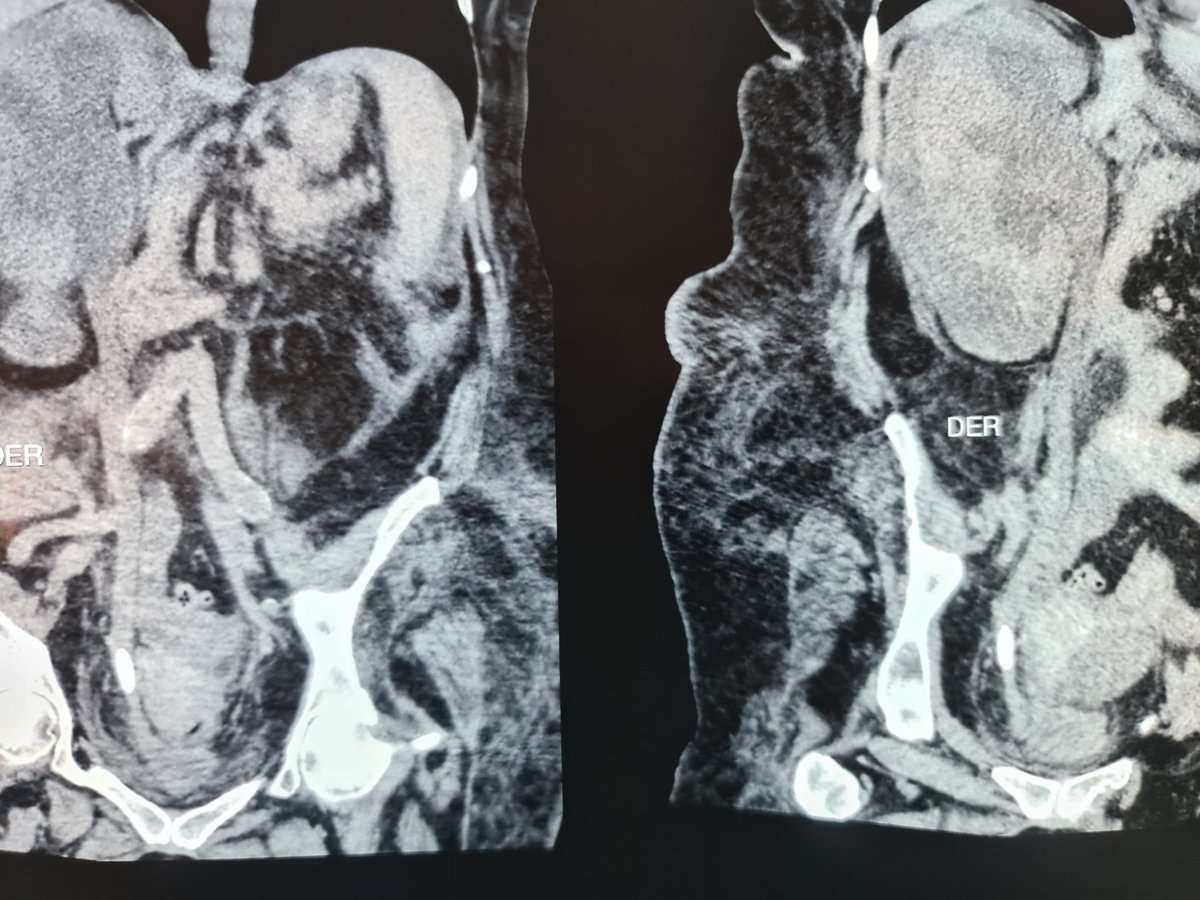 AlexUroPriego's tweet photo. #urology 
#UroChallenge 
#ChallengeAccepted 
#Lovemyjob https://t.co/SKqtTfCOVQ