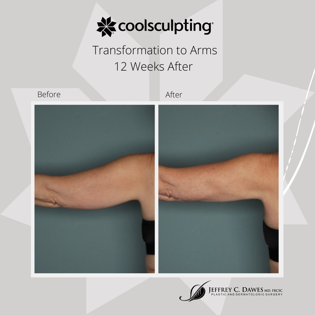 JeffreyCDawesMD's tweet image. Transform your arms without surgery or downtime! CoolSculpting allows you to sculpt areas and reduce fat for good! Book a consult during Cool Week to learn more April 5th-9th! 
#coolsculpting #weightlossjourney #bodysculpt #beforeandafter #nonsurgicallipo #freezefat