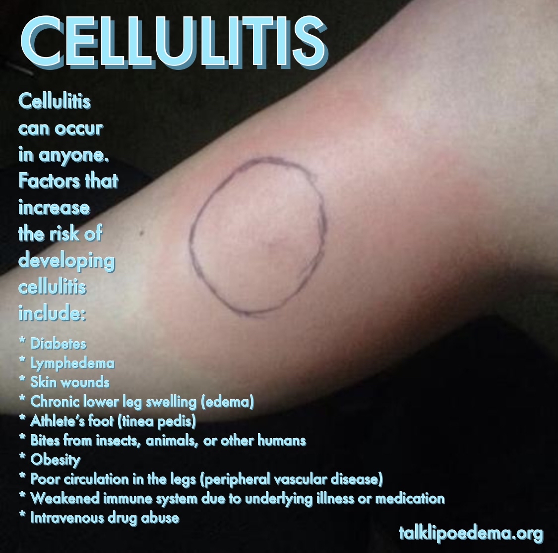 TalkLipoedema on Twitter: TalkLipoedema on Twitter:
