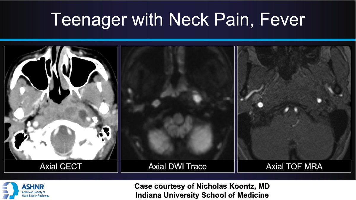 #ASHNRCOTW #145: Teenager w/ Neck Pain, Fever. Diagnoses (plural)? Thx <a href="/nakoontz/">Nicholas Koontz</a> <a href="/IURadiology/">IU Radiology and Imaging Sciences</a> 4 case! #ASHNR21

Answer w/ appropriate GIF only -- stay professional &amp; don't spoil it!

<a href="/callyrobs/">Caroline Robson, MBChB</a> <a href="/DShatzkes/">Deborah Shatzkes</a> <a href="/CDP_Rad/">C Douglas Phillips 🇺🇸</a> <a href="/rhwiggins/">Richard Wiggins</a> <a href="/cmtomblinson/">Courtney Tomblinson, MD</a> @CincyPedsNeuro <a href="/ESHNRSociety/">ESHNR</a> <a href="/AnnJayMD1/">Ann Jay MD</a>