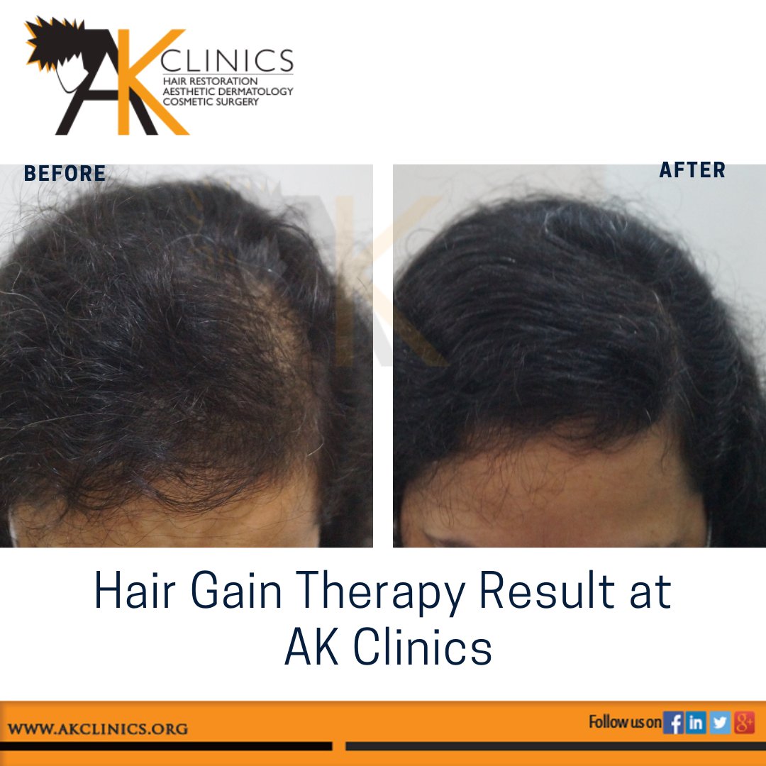 amanakclinics's tweet photo. Our signature Hair Gain Therapy shows commendable results in most patient …
#HairGainTherapy #HairGainTherapyResults  #HairLossTreatment #HairTreatment #BeforeAfter #HairGrowth #HairAndSkinClinic  #Dermatologist #AKClinics #DrKapilDua #DrAmanDua  #Ludhiana #Delhi #Bengaluru https://t.co/AvNhTRyesd