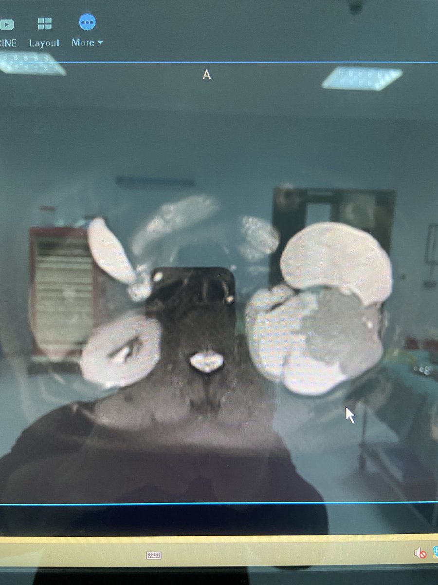 Upper tract TCC in 30 cm giant hydronephrotic kidney... open radical nephroureterectomy + LND with ⁦<a href="/bicaklioglu_f/">Fatih Bıçaklıoğlu</a>⁩ ⁦<a href="/DMomoch/">dr.momoch</a>⁩ at ⁦<a href="/trabzonkeah/">Trabzon Kanuni Eğitim ve Araştırma Hastanesi</a>⁩ 👍👍👍