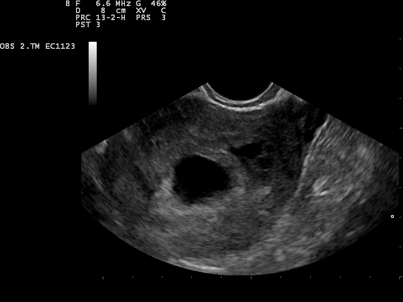 AlexBirchMW's tweet image. Interesting question – what is a ‘chemical pregnancy’? An early pregnancy loss that occurs shortly after implantation.  #wlvmidwiferyteam #USS #firsttrimesterscan #estimatinggestation @wlv_health #allcohortsday