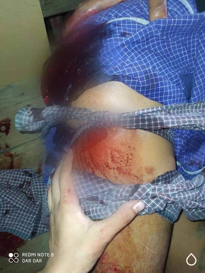 Jacobs59461215's tweet photo. death
Military junta terrorists used hand grenades n RPG in South Dagon, Yangon. At least 10civilians has been killed and many got injured. Both mobile n wifi internet is known to be cut off in some areas of South Dagon. 
#DoYouknow
#WhatsHappeningInMyanmar https://t.co/6SuveSzJgt