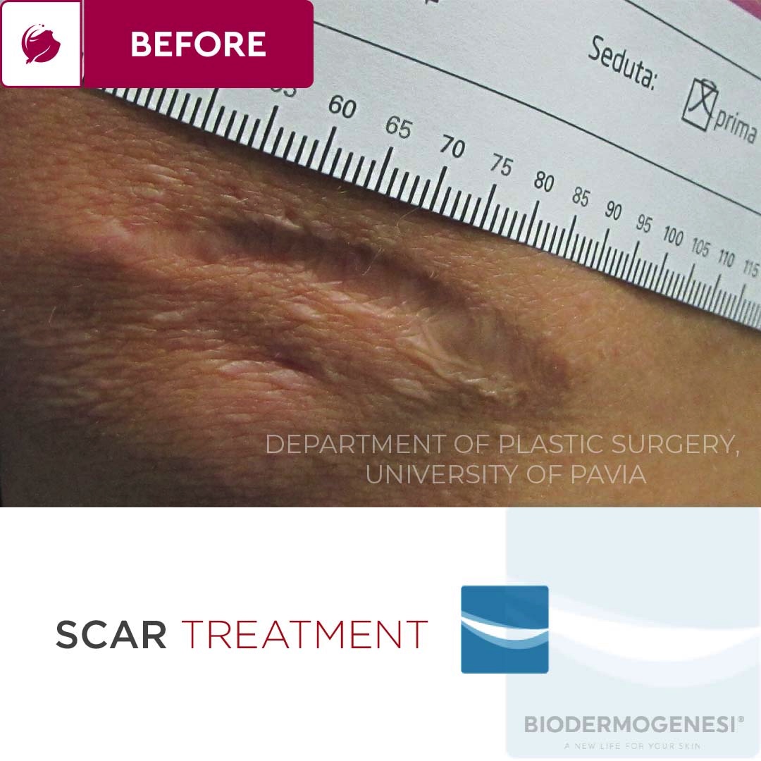 FusionGtUk's tweet photo. ✨Incredible Results with #Biodermogenesi Dermacare! With #Biodermogenesi Dermacare you can treat:
#HypotrophicScars #Hypertrophic #Scars #BurnScars
#Keloids

For more information, contact us :
📧 info@fusiongt.co.uk
📞 0207 481 1656
💻 https://t.co/bCqWljY12H

#ukaesthetics https://t.co/AqG3zEv0DB