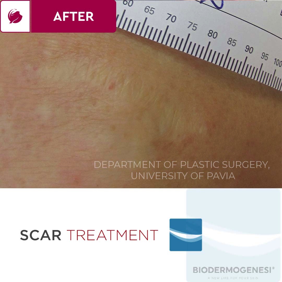 FusionGtUk's tweet photo. ✨Incredible Results with #Biodermogenesi Dermacare! With #Biodermogenesi Dermacare you can treat:
#HypotrophicScars #Hypertrophic #Scars #BurnScars
#Keloids

For more information, contact us :
📧 info@fusiongt.co.uk
📞 0207 481 1656
💻 https://t.co/bCqWljY12H

#ukaesthetics https://t.co/AqG3zEv0DB