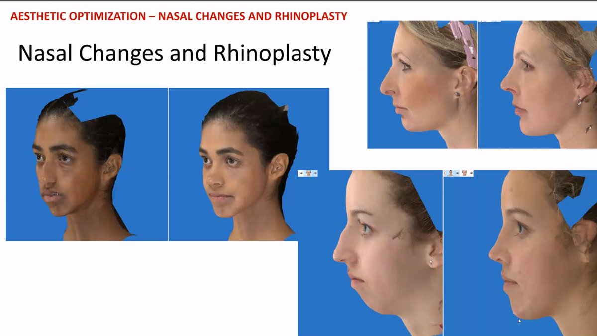 CleClinicHNI's tweet image. Thanks @SteinBeastMD for sharing your knowledge of nasal deformity &amp;amp; Orthognathic Surgery with us at Grand Rounds! @Yale_ENT ccf.org/headnecklive