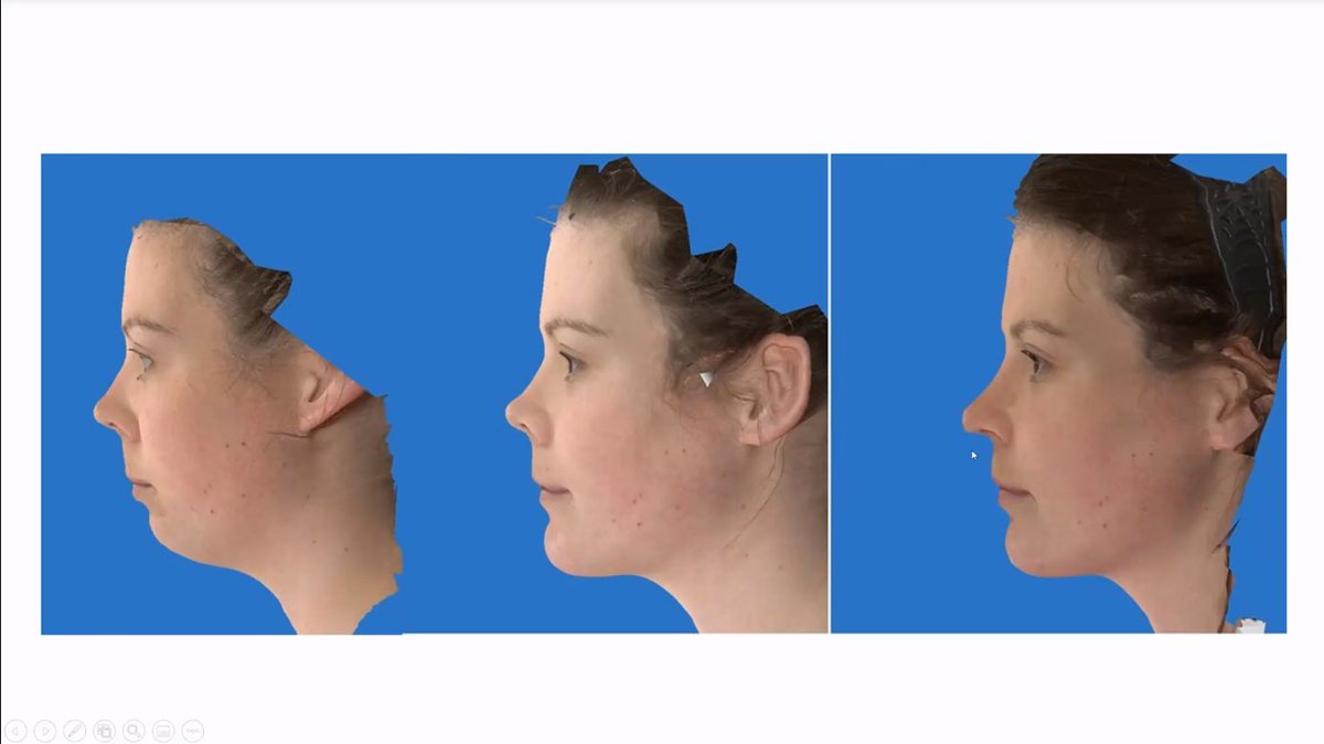 CleClinicHNI's tweet image. Thanks @SteinBeastMD for sharing your knowledge of nasal deformity &amp;amp; Orthognathic Surgery with us at Grand Rounds! @Yale_ENT ccf.org/headnecklive