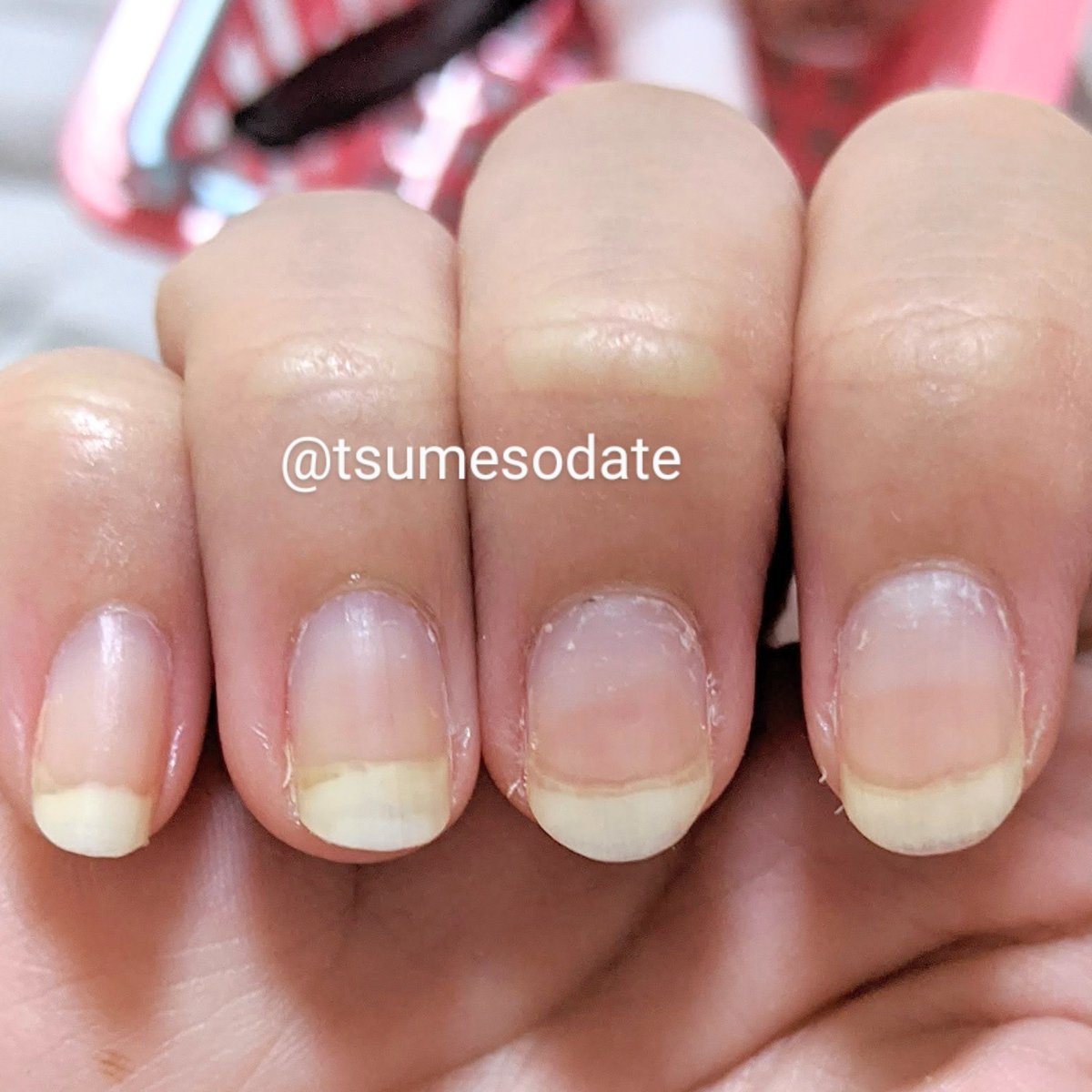 よこお 育爪 反り爪 巻き爪 深爪 Tsumesodate Twitter よこお 育爪 反り爪 巻き爪 深爪 Tsumesodate Twitter