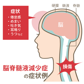 脳脊髄液減少症のtwitterイラスト検索結果
