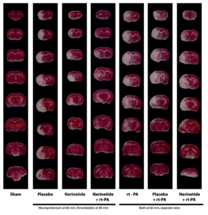 ScienceTM's tweet photo. Why does #nerinetide fail to protect the brain after #stroke alongside #alteplase? A new study now might have the answer, and shows separating doses or using a peptide derivative of nerinetide restores efficacy in rat models. @tymianski @physiologyuoft https://t.co/DgYQPKkTul https://t.co/ZfJ3KTBVGI