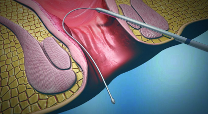 cjmedicaluk's tweet photo. FiXcision for circumferential tissue removal to treat simple anal fistulas - steps available on https://t.co/jYCmp8X55h #analfistulas #coloproctology https://t.co/PONQR4ZUz2 https://t.co/p8u6iwMvuK