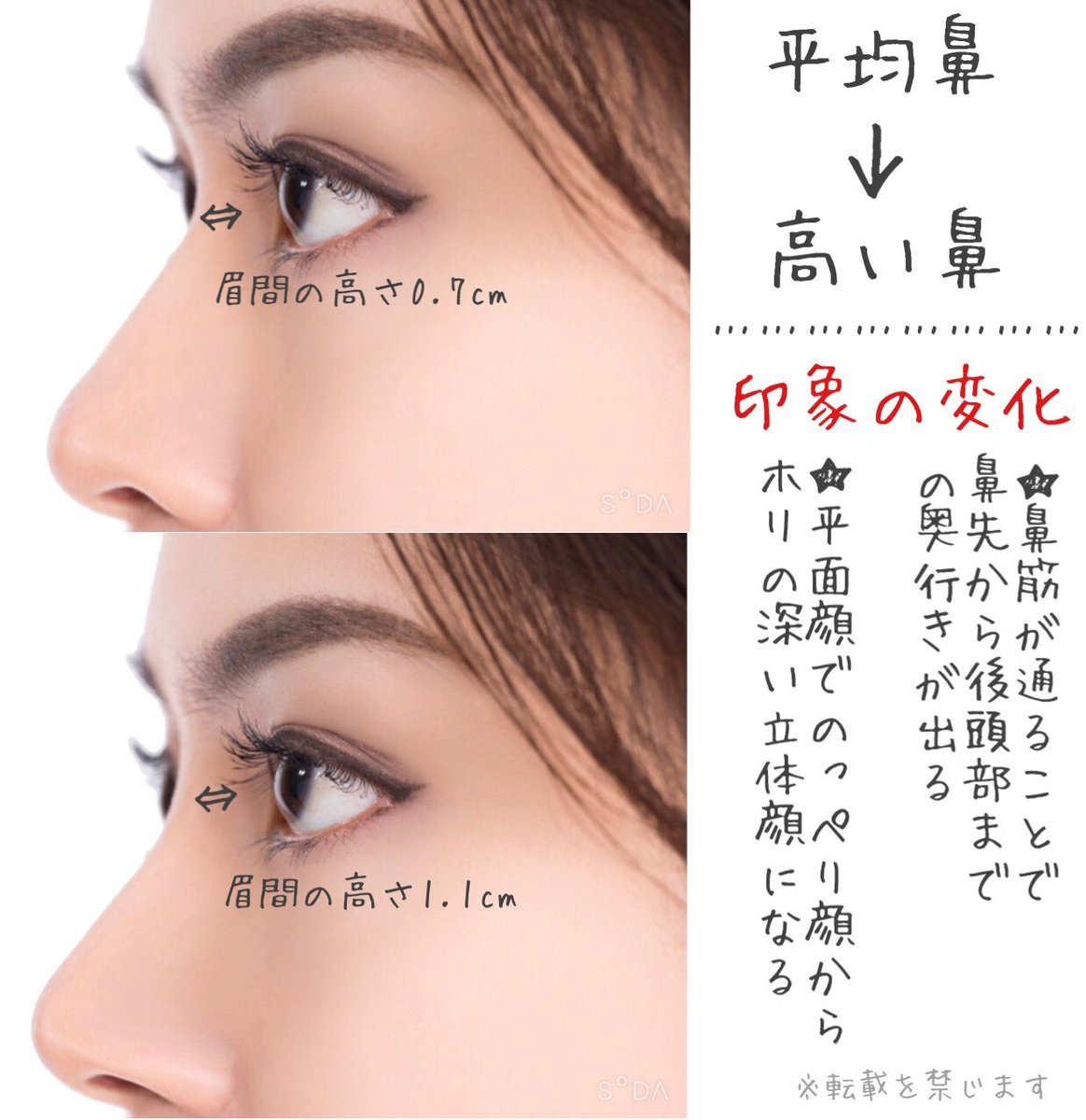 鼻整形の名医相談 小鼻縮小 鼻翼縮小 鼻尖形成 鼻中隔延長 鼻尖縮小 二重整形 プロテーゼの失敗 のっぺり顔の人が鼻を高くすると下記の様な印象の変化が出る 短い鼻の改善 目と目の間が近く見える 5mm位の超高いプロテを入れない限り実際には