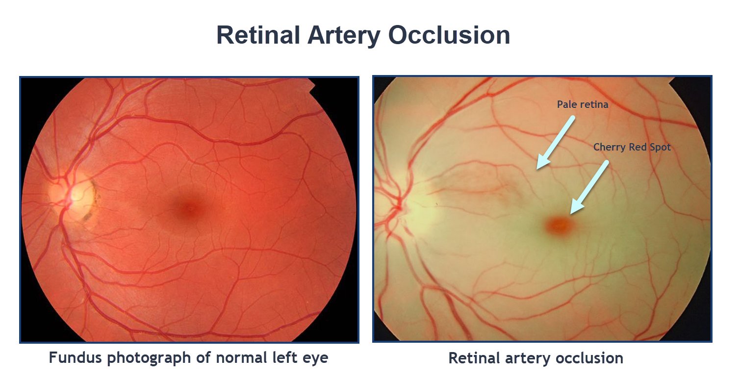 Central Retinal Artery Occlusion Cherry Red Spot