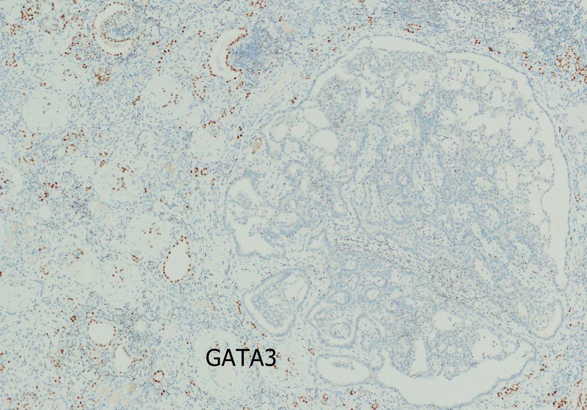 aloa0's tweet photo. @Williamson_SR @slusagar @EKoubaMD @KhaleelAlObaidy GATA3 stains as predicted. https://t.co/LWX8cvPCTF