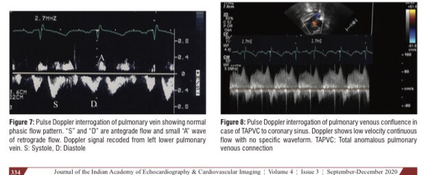 cardiopedhnn's tweet image. Evaluación de anormalidades de #venas_pulmonares x #echofirst

- en #
- en conexión (parcial, total; sin / con obstrucción)
- en drenaje (parcial, total)
- presencia de estenosis (local, difusa)

jiaecho.org/article.asp?is…

#cardiopedia  #pedscard  #CHD @SISIACOficial