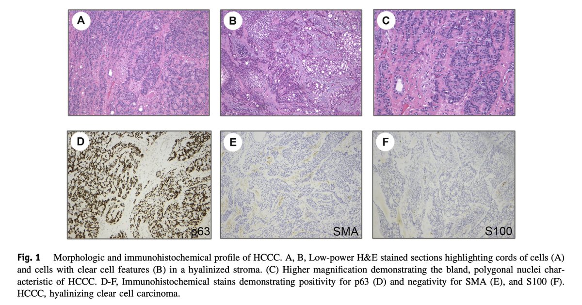 Human_Pathology's tweet photo. #HumPathol
Gubbiotti et al. (@MariaGoobs) present all cases of #HCCC from their institution alongside a comprehensive literature review spanning 2015–2020 - steps that help characterize this unusual malignancy.
cc: @ktmontone @LivolsiVirginia @aakasharmand https://t.co/TRNX4OMcP0