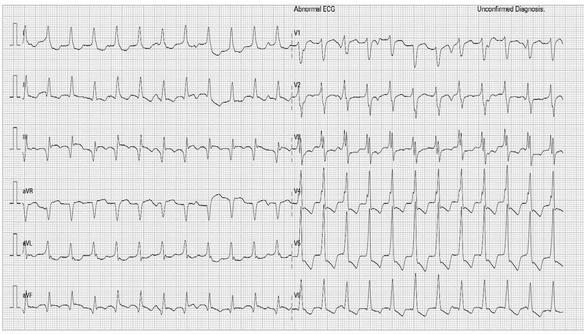 escardio's tweet photo. Let's get in the mood for the #EHRA2021 ECG competition session.

67 yo patient with no history of heart disease presents to the ER with dizziness and palpitations. Poll 👇

#EHRA_ESC #EPeeps #ECG #cardiotwitter #ecgquiz https://t.co/XY4GjlvtdU