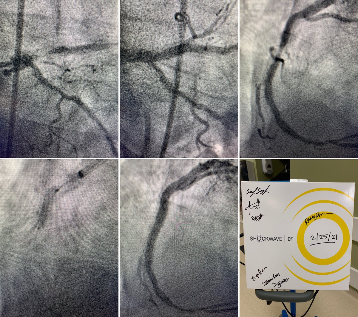 Shockwave Medical (@shockwaveivl) on Twitter photo 3 vessel disease, PCI of Ostia/Prox LAD, NC balloon unsuccessful. 40 pulses of 3.5x12 #ShockwaveC2, finished w/ 4.0x18 DES. RCA for 20 pulses of same C2, finished w/ 3.5x38 DES. Outstanding result by Dr. Sameh Sayfo at <a href="/bswhealth/">Baylor Scott & White Health</a> Heart Hospital Plano!
ISI bit.ly/3rnUXue 3 vessel disease, PCI of Ostia/Prox LAD, NC balloon unsuccessful. 40 pulses of 3.5x12 #ShockwaveC2, finished w/ 4.0x18 DES. RCA for 20 pulses of same C2, finished w/ 3.5x38 DES. Outstanding result by Dr. Sameh Sayfo at <a href="/bswhealth/">Baylor Scott & White Health</a> Heart Hospital Plano!
ISI bit.ly/3rnUXue