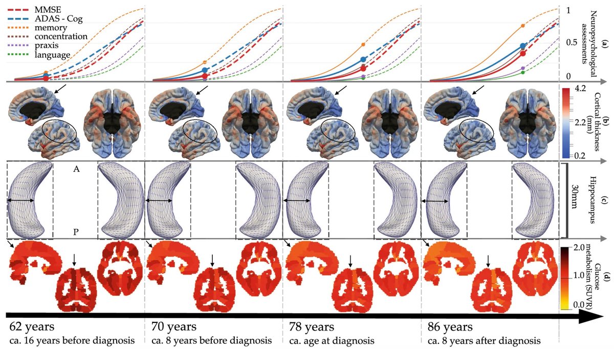Ever wanted to see how #brain and cognition changes over 30 years of #Alzheimer disease progression?
👉 C/o our paper published today at <a href="/SciReports/">Scientific Reports</a>: nature.com/articles/s4159…
👉 app: files.inria.fr/digitalbrain/

<a href="/Euro_POND/">EuroPOND Consortium</a> <a href="/ApitiusHofmann/">Hofmann-Apitius 🇺🇦🇮🇱🇵🇱</a> <a href="/harald_hampel/">Harald Hampel, MD, PhD, MSc, MA</a> <a href="/PTenigma/">Paul Thompson</a>  <a href="/HolgerFroehlich/">Holger Fröhlich</a>