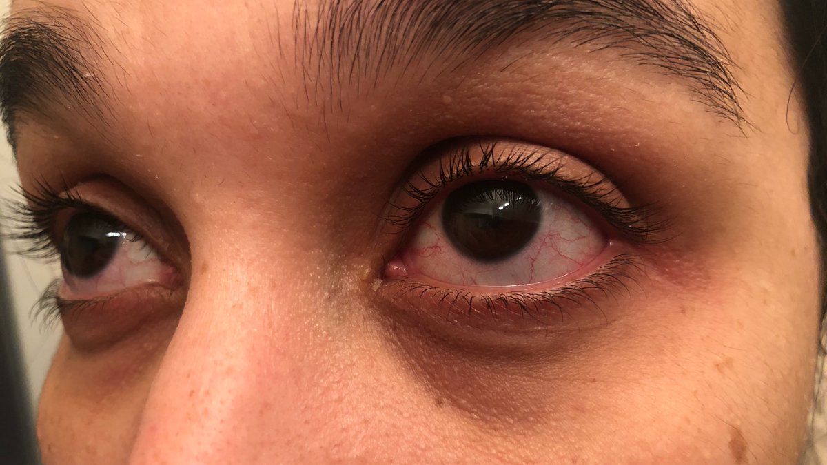 As a biracial immigrant in Canada, having  #longCOVID w/ a (-) test means that I have been met with so much medical racism in form of overt discrimination or dismissal. I had to see 3 MDs before getting prescribed something to treat bilateral eye inflammation.  #1year1virus 8/