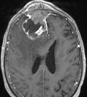 neurosurgatlas's tweet photo. Try this practice exercise based on #NeurosurgicalAtlas content. Comment your answer below! Discussion welcome and encouraged, good luck! 
@benkhendricks 
#MedTwitter #Neurosurgery #NSGY #surgery https://t.co/94zd2qIBzv