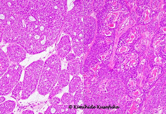 KusafukaK's tweet photo. 45y/o. M. Unpainful parotid mass.
Whats your Dx.?
What kinds of IHC are needed?
#entpath #surgpathol #Tweetaward https://t.co/TFz1FUsVKU