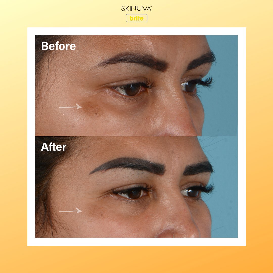 Are Dark Circles Melasma?