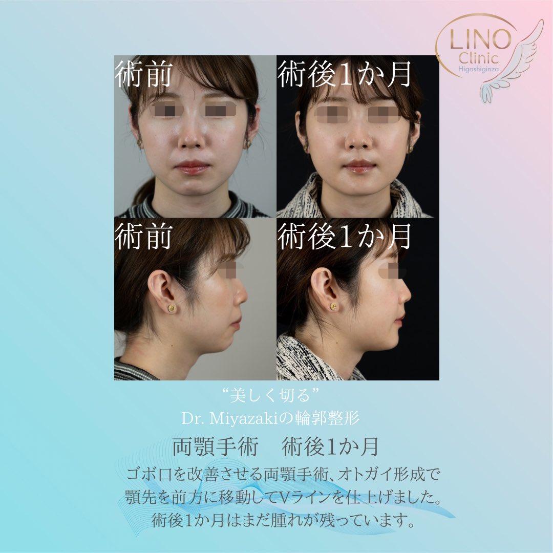 両顎手術の宮崎先生 骨切りのことは何でもお任せ Auf Twitter ゴボ口を治す両顎手術 術後1か月のdtです 横顔も可愛くなりました まだ腫れが残っています 両顎手術 顎矯正手術 小顔 歯列矯正 輪郭3点 輪郭