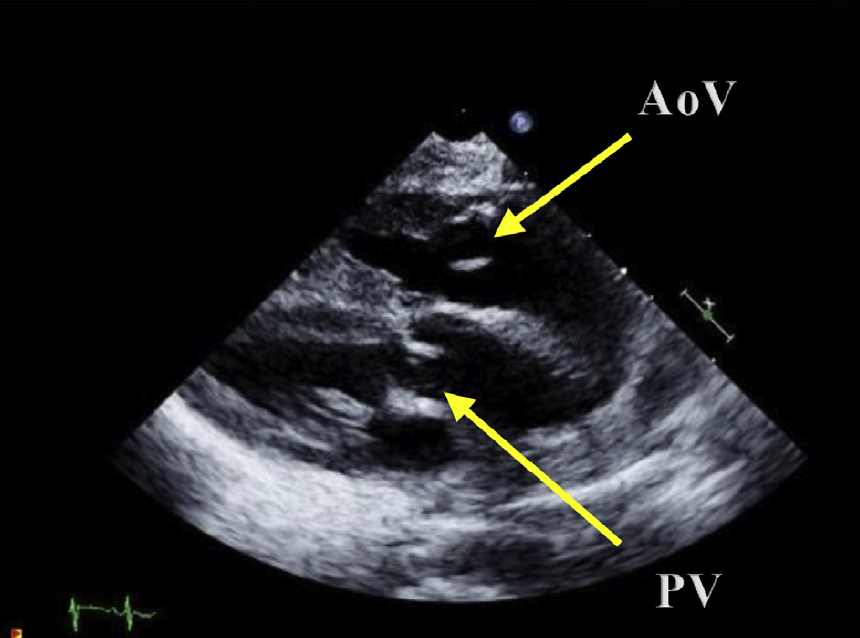 bifflandeck's tweet photo. @iamritu @MelisWasserman @edwardagill @rajdoc2005 @PushpaShivaram @DrJenniferCo_Vu @DocStrom @FredWuMD @daniel_forsha @DavidWienerMD Parallel great vessels in parasternal long axis view #echofirst #ASEchoJC @ASE360 https://t.co/5i6cwV2gdq