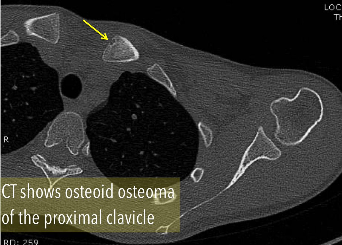interventistica's tweet photo. Young woman, 27 yo
osteoid osteoma of the clavicle
Proposed treatment: percutaneous radiofrequency ablation 
Prof Gianpaolo Carrafiello Dr Anna Maria Ierardi #InterventionalRadiology https://t.co/xW5wTGY7PG