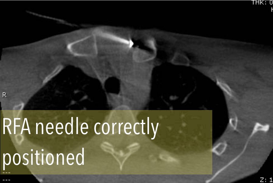 interventistica's tweet photo. Young woman, 27 yo
osteoid osteoma of the clavicle
Proposed treatment: percutaneous radiofrequency ablation 
Prof Gianpaolo Carrafiello Dr Anna Maria Ierardi #InterventionalRadiology https://t.co/xW5wTGY7PG